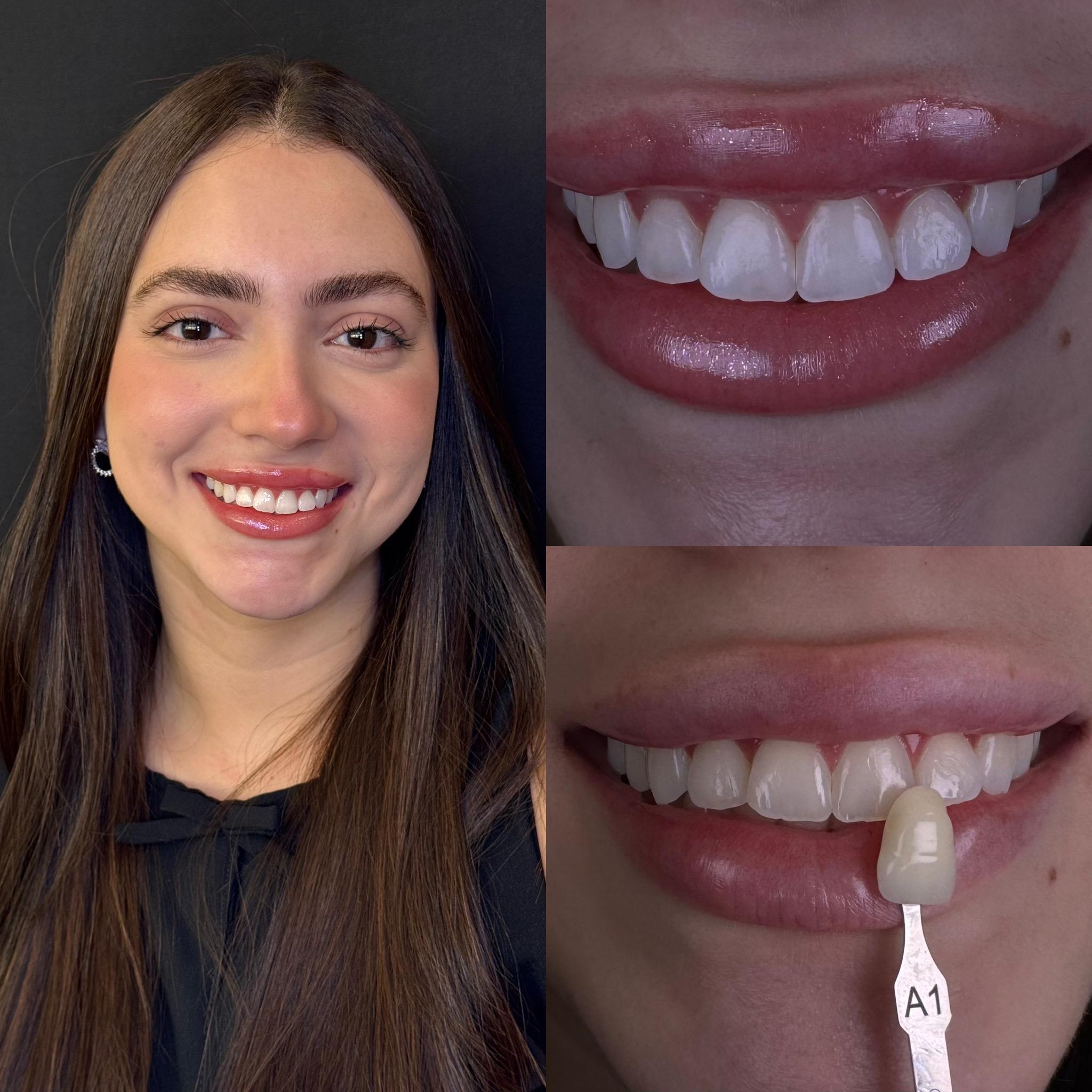 Facetas