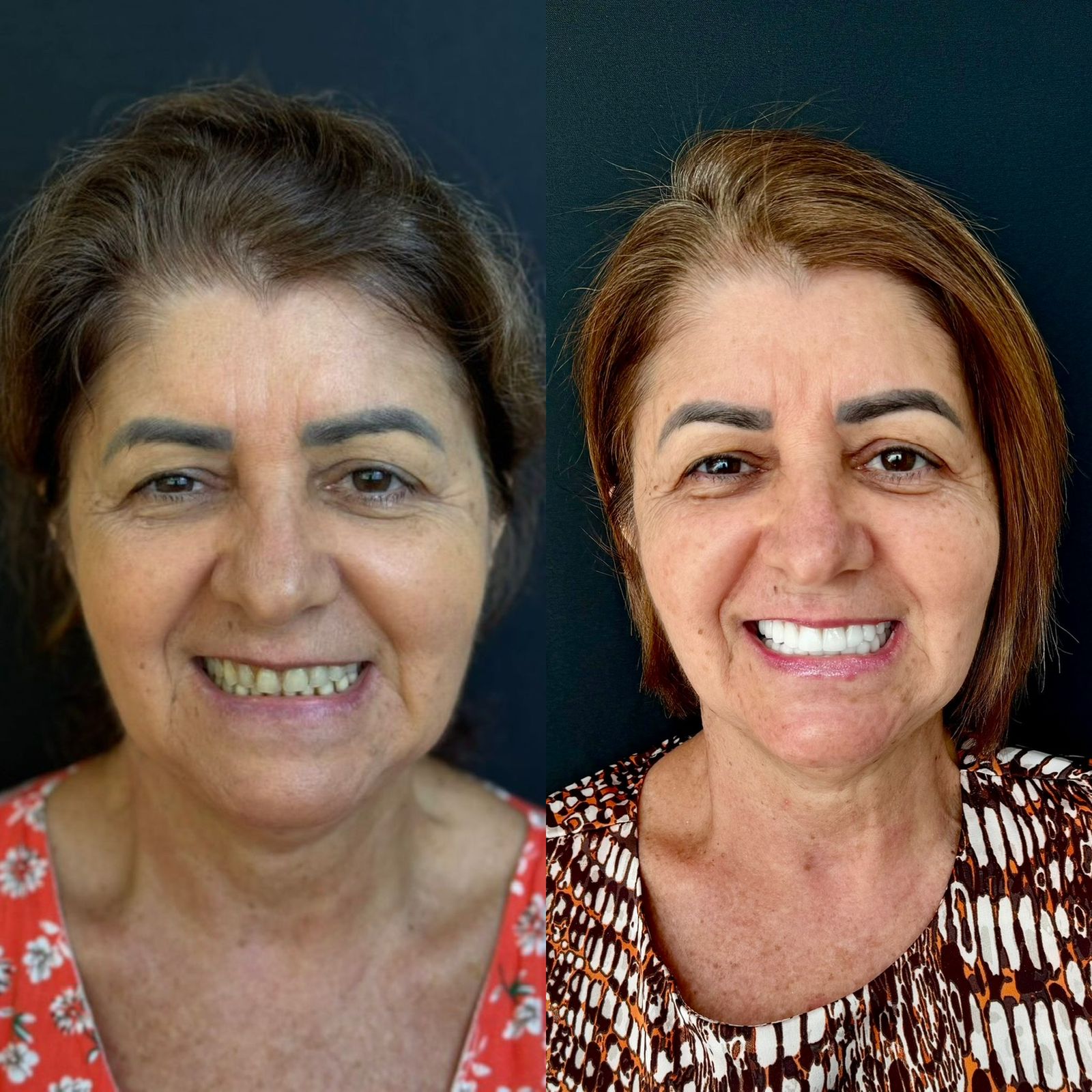 Facetas