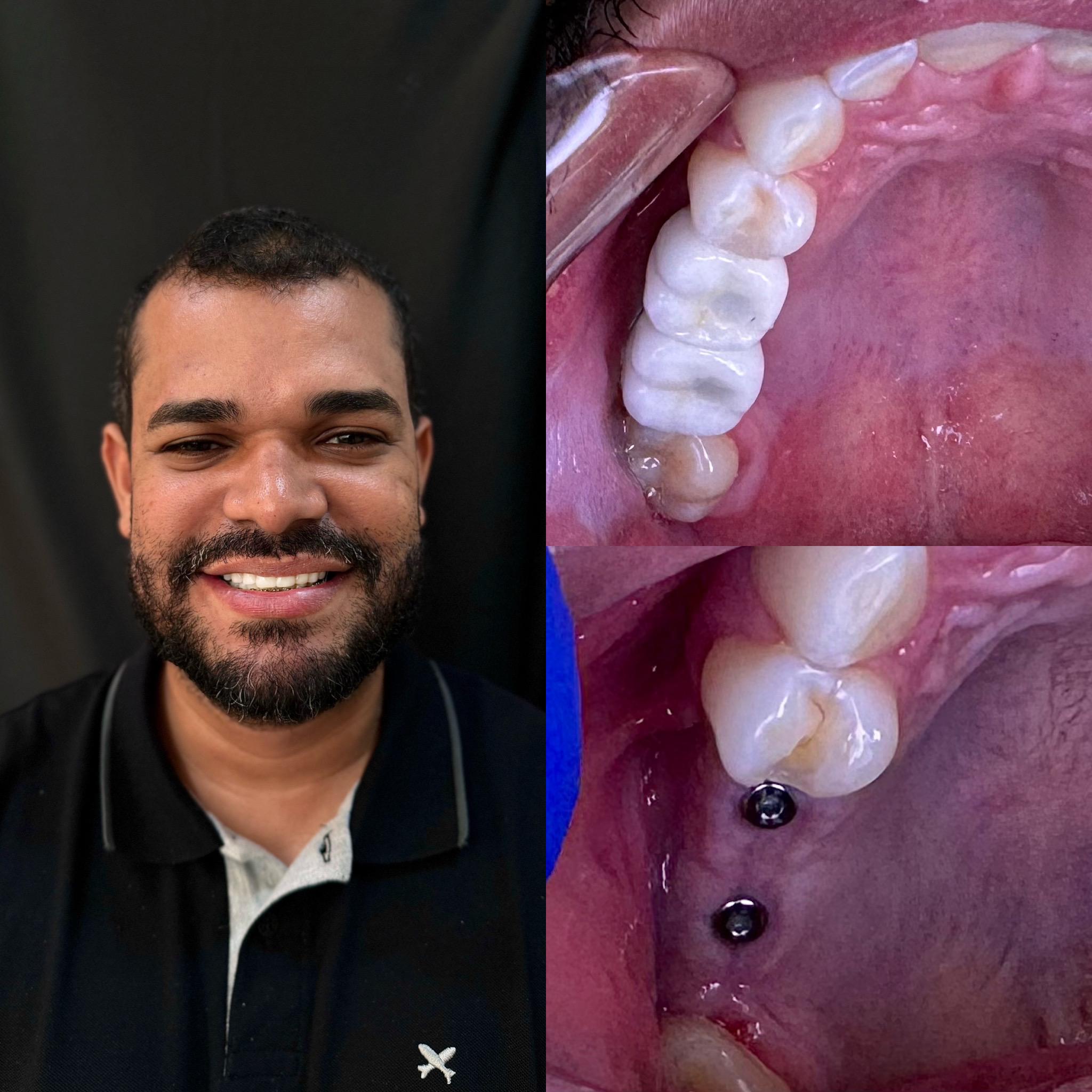 Implantes